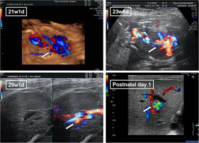 Case report: A case of fetal umbilical vein varix presenting disseminated intravascular coagulation, polycythemia, and neonatal hepatitis in an extremely low birth weight infant